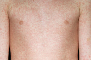Measles rash on the chest of a 10-year old boy with light skin.