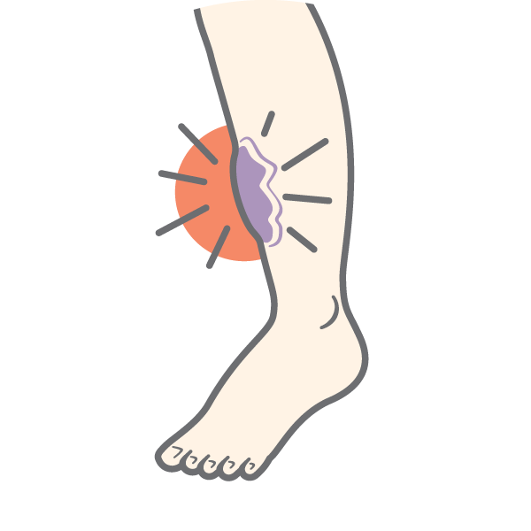 Illustration of a leg with a grey area on it, and a red circle with lines to indicate pain