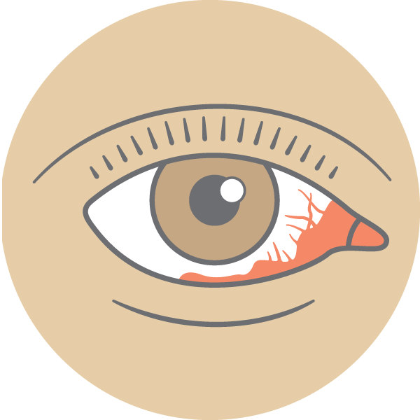 Illustration of an eye with some blood on it