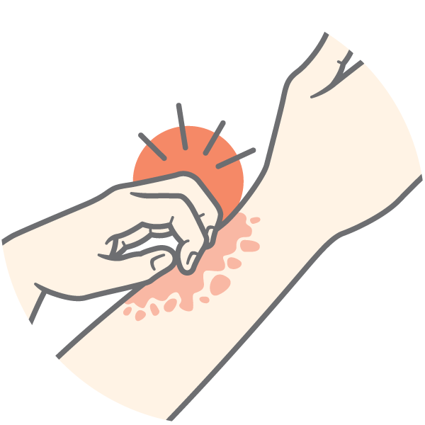 Illustration of an arm with some rush on it. A hand scratches the itch, with a red circle and lines to signify itching.